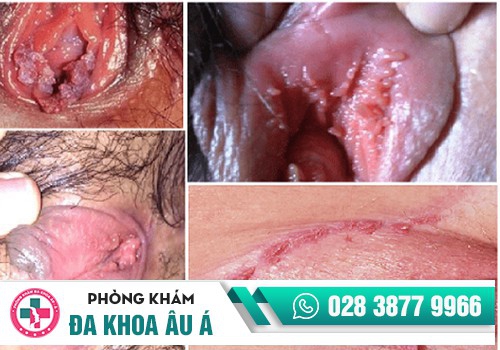 Hình ảnh sùi mào gà ở âm đạo