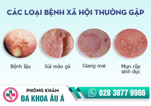 Các bệnh da liễu, bệnh xã hội thường gặp