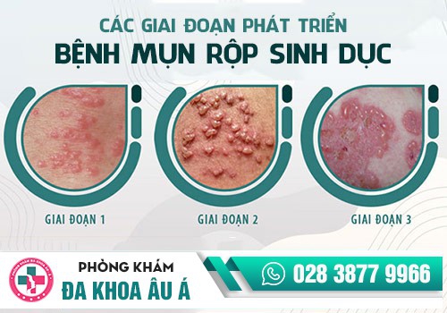 Triệu chứng mụn rộp sinh dục